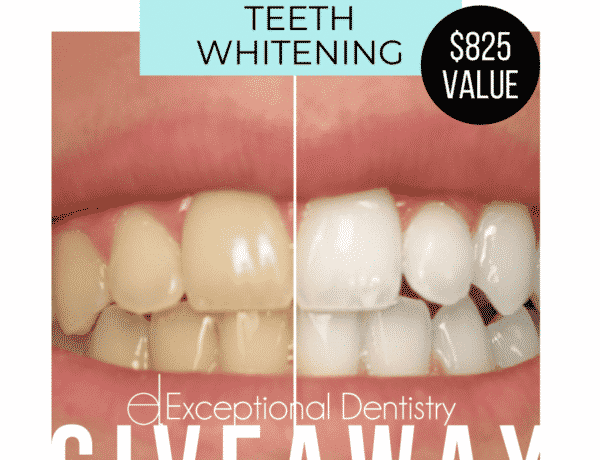 Professional home teeth whitening complete review giveaway