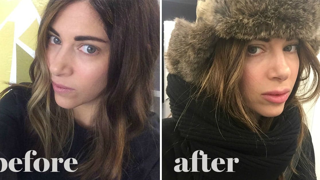 thoughts on lip injections